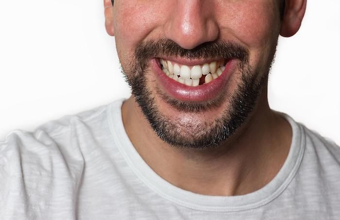 closeup man with missing tooth