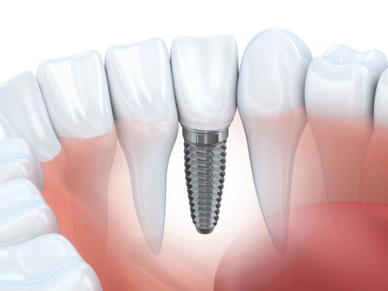 dental implants 3d image illustration