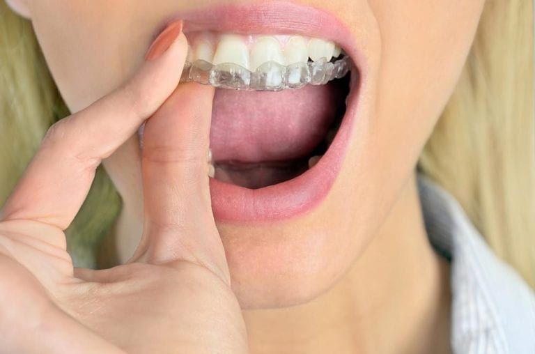 closeup teeth with clear aligners