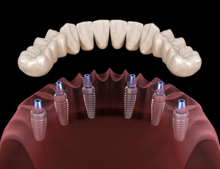 implant support dentures 3d image