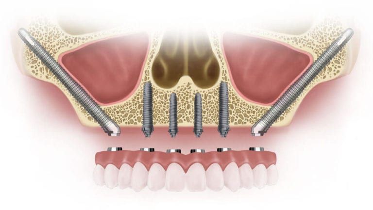 zygomatic implants 3d illustration