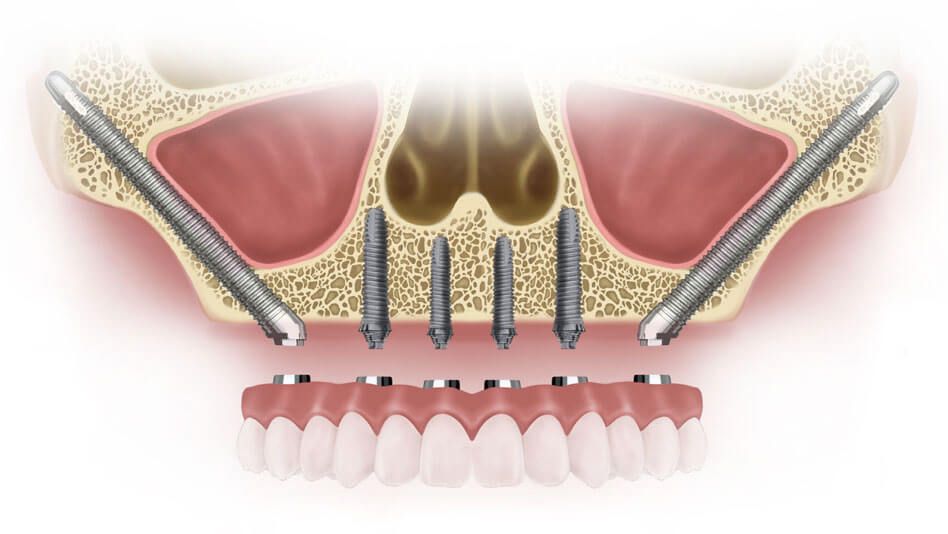 zygomatic implants 3d illustration