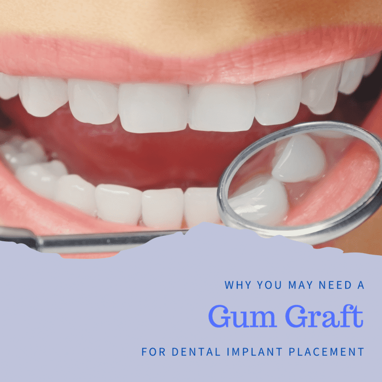 Why You May Need a Gum Graft for Dental Implant Placement