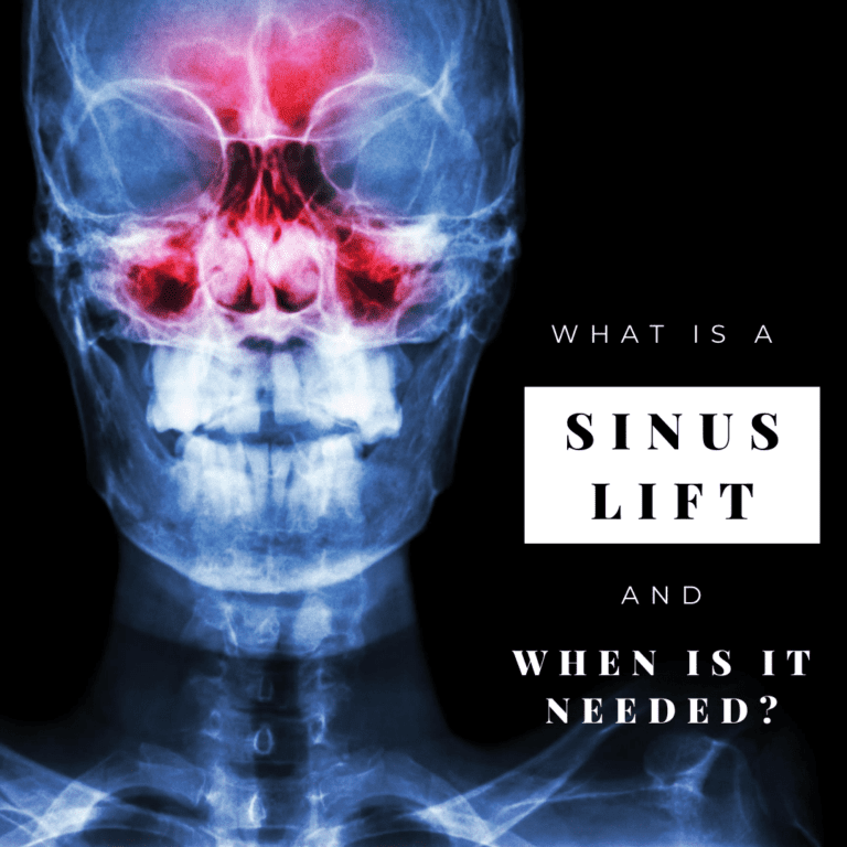 what is a sinus lift and when is it needed