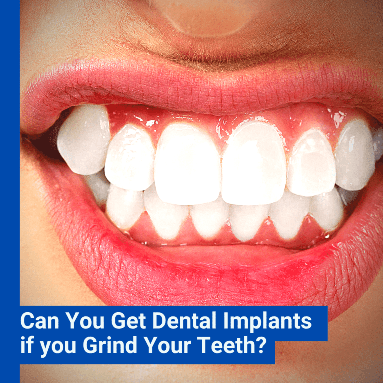 Can You Get Dental Implants if you Grind Your Teeth_