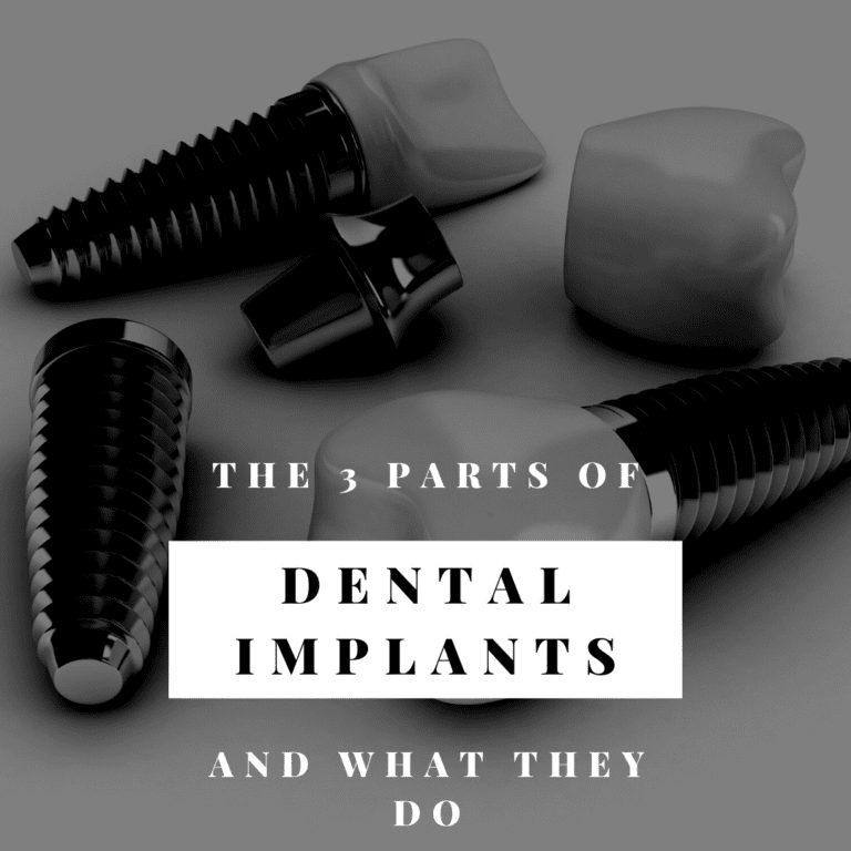 The 3 parts of dental implants and what they do