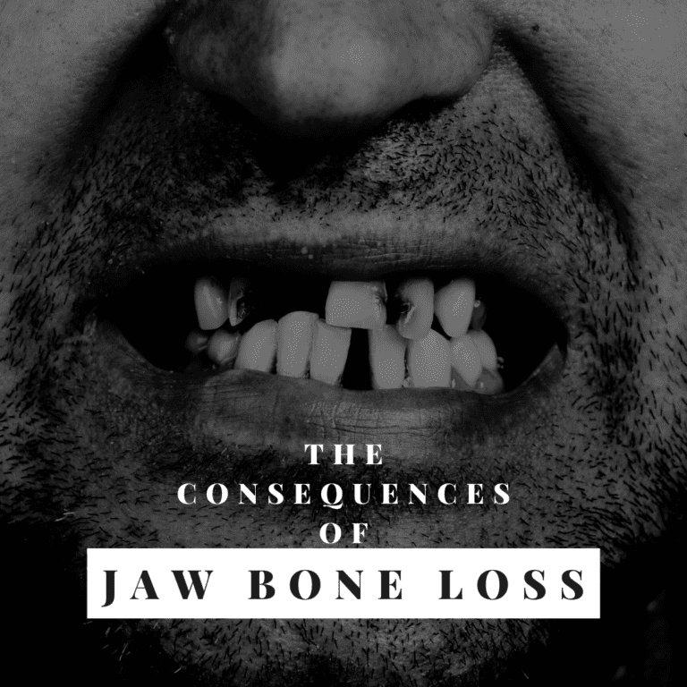 The Consequences of jaw bone loss