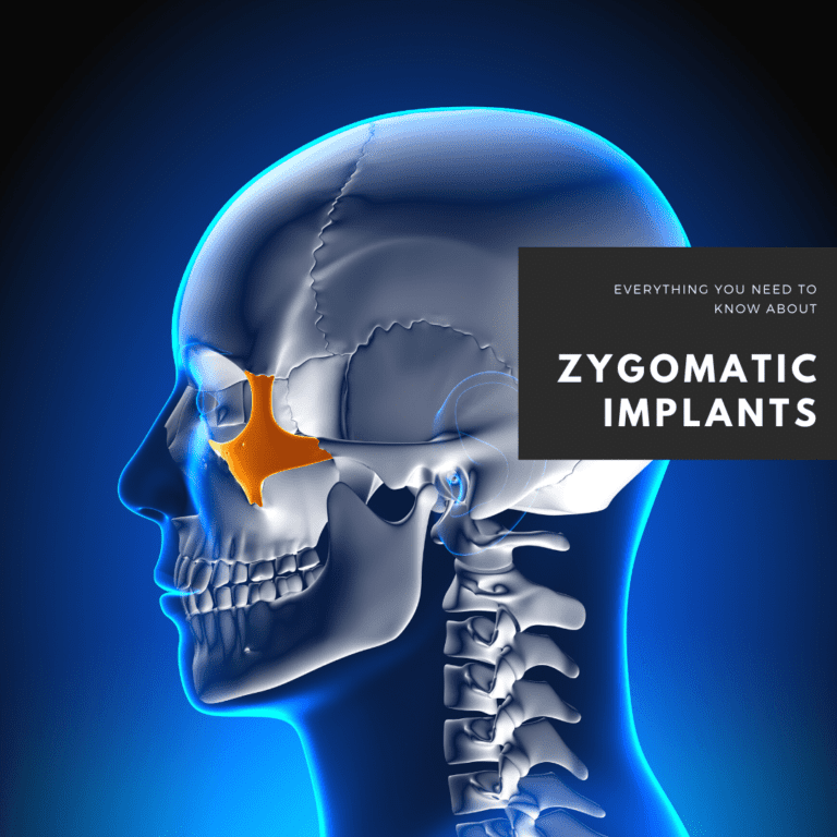 Zygomatic Implants