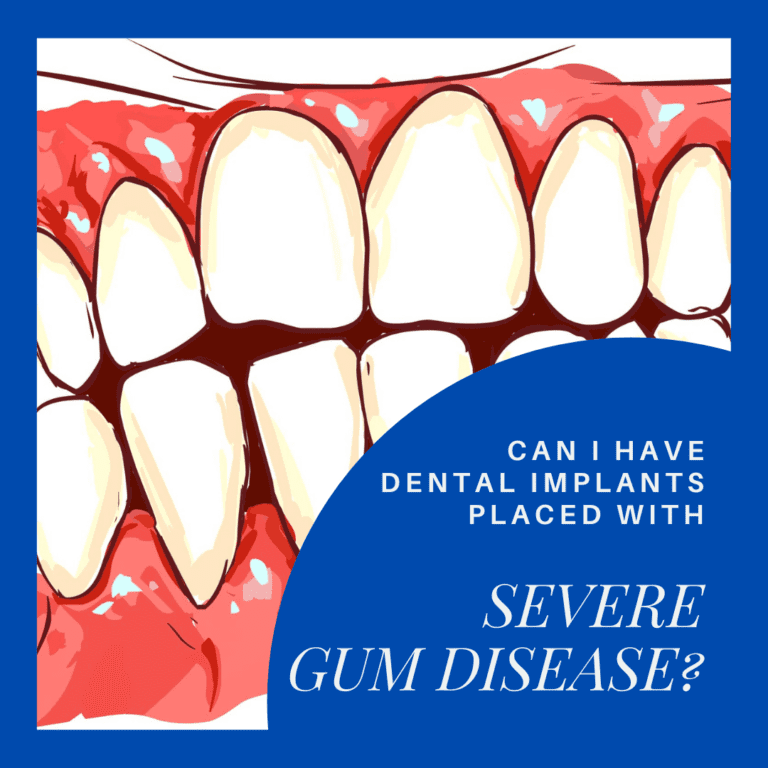 Can I have Dental Implants placed with severe gum disease