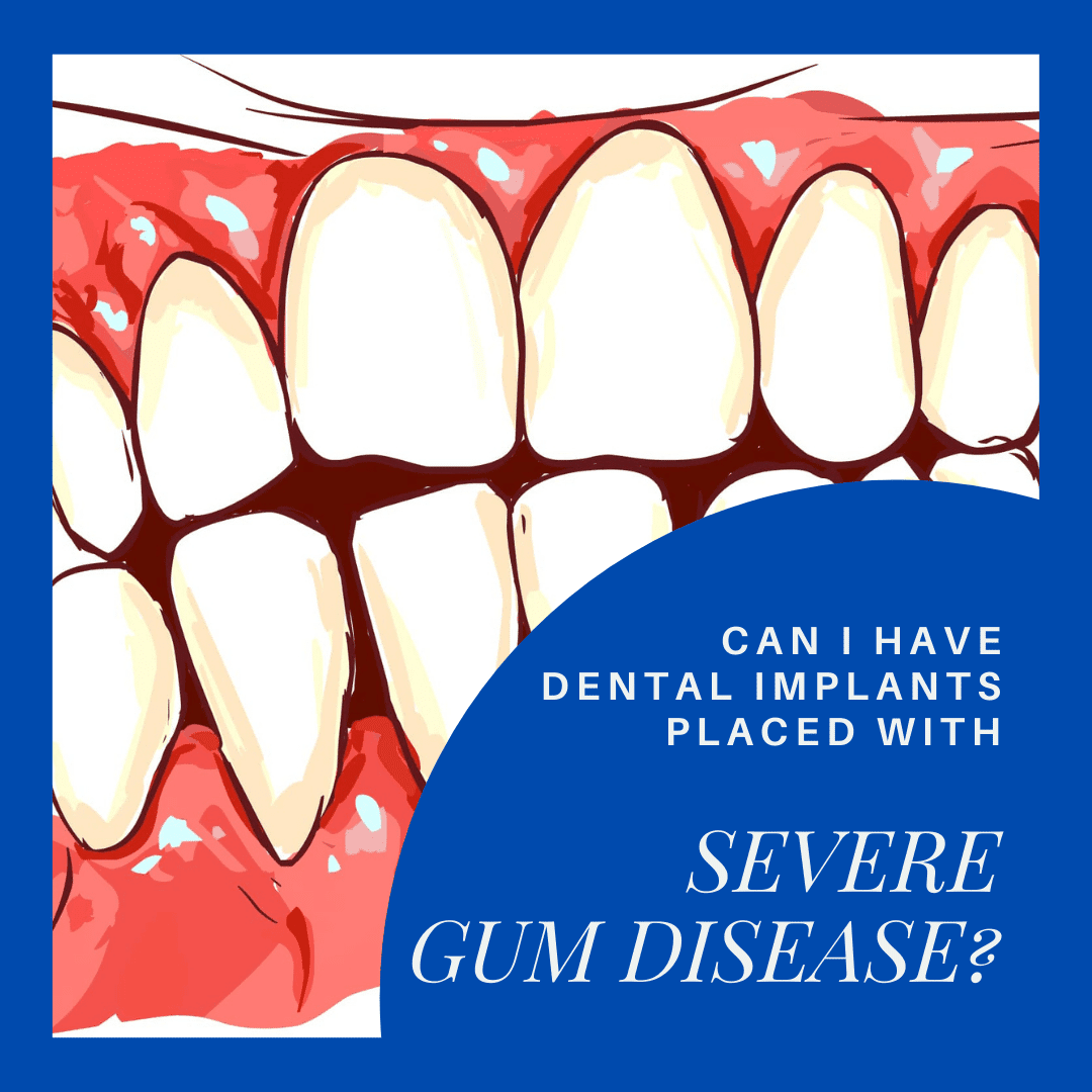 can-i-have-dental-implants-placed-with-severe-gum-disease-chicago