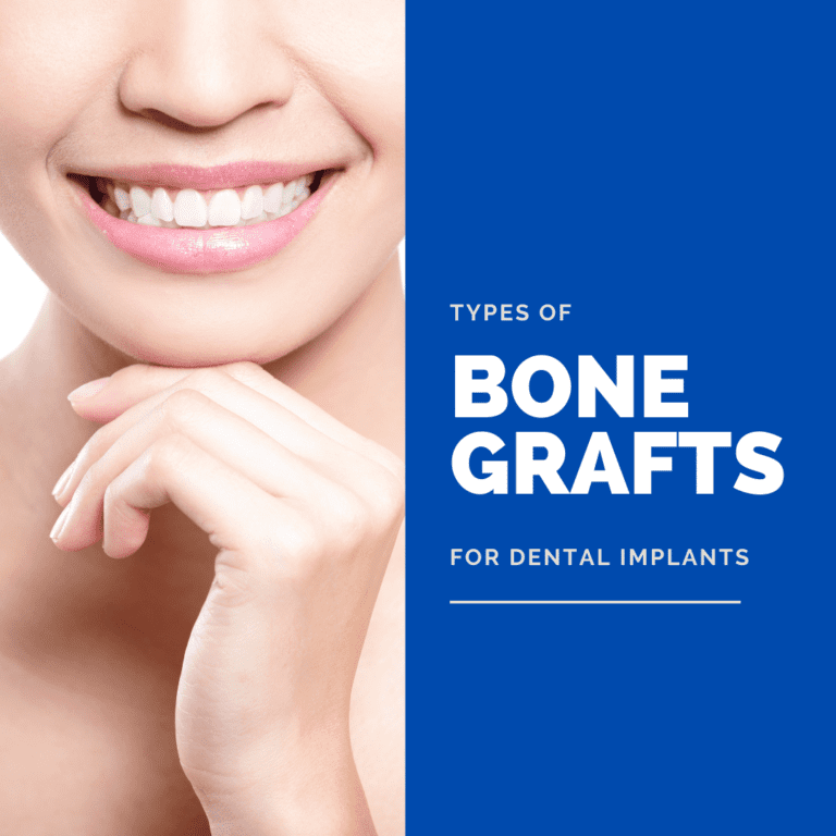 Types of bone grafts for dental implants