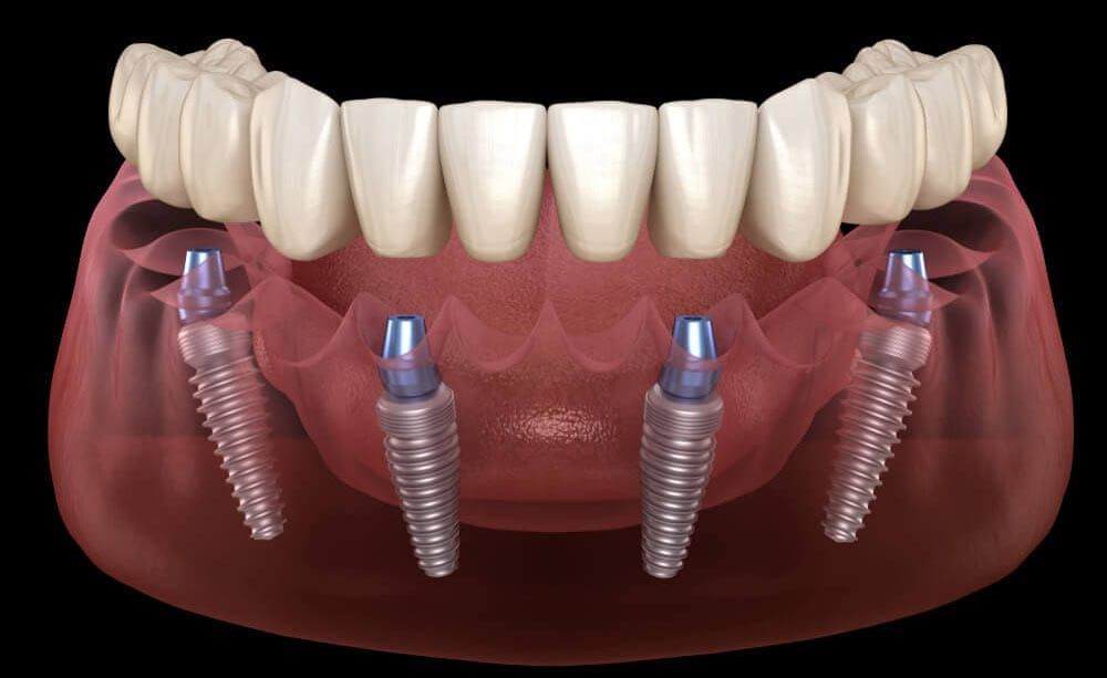 all- on-four implants