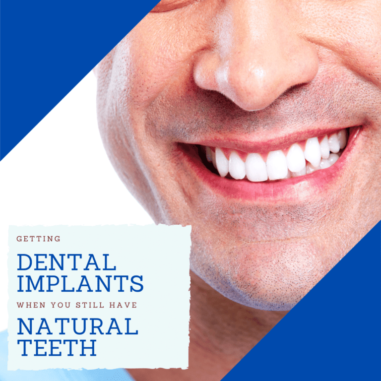 Getting Dental Implants when you still have natural teeth
