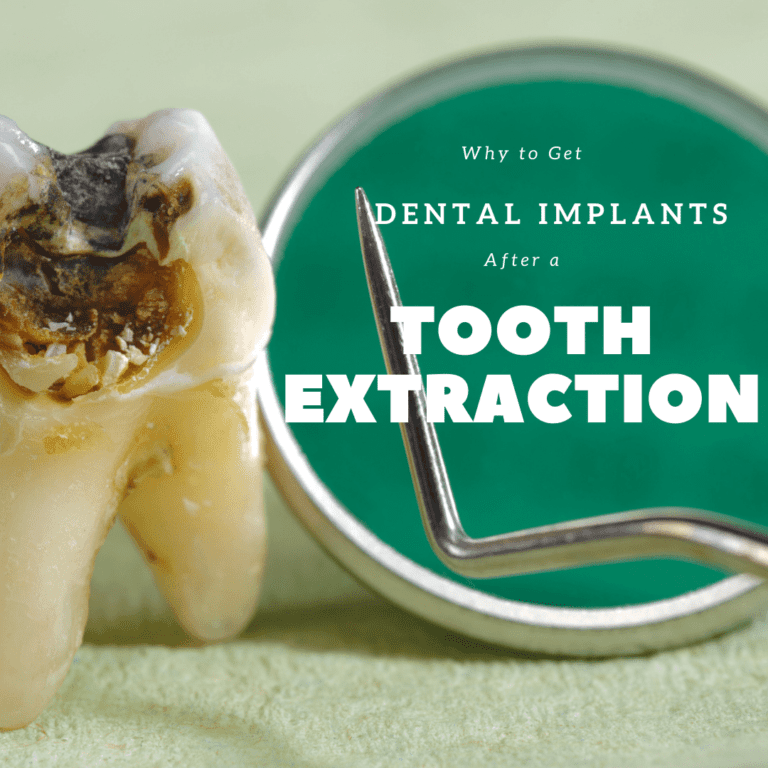 Why to Get Dental Implants After a Tooth Extraction