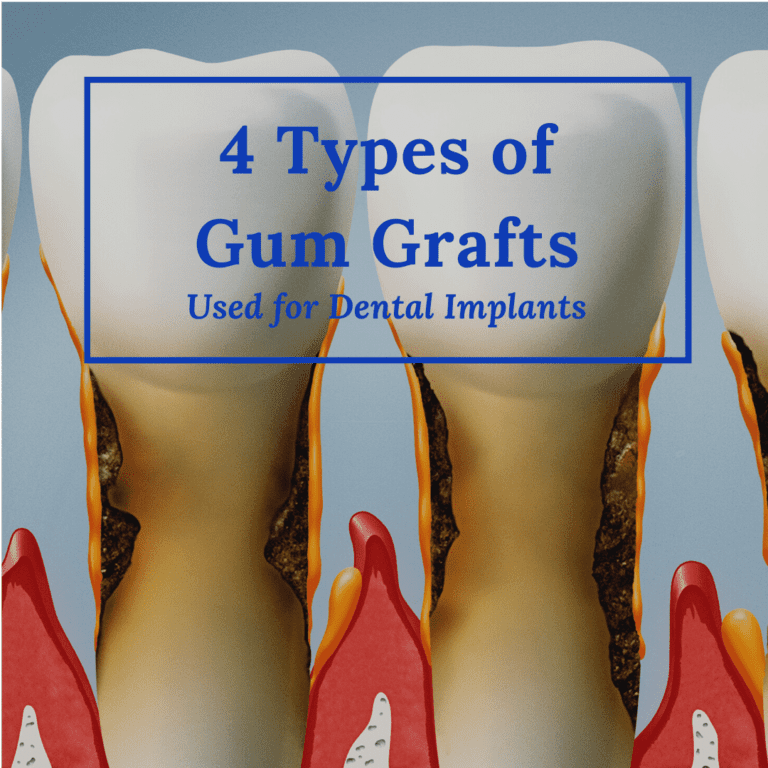 4 Types of Gum Grafts