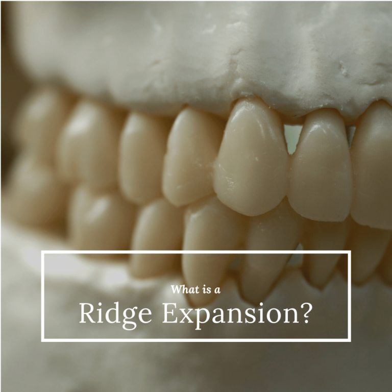 What is a ridge expansion