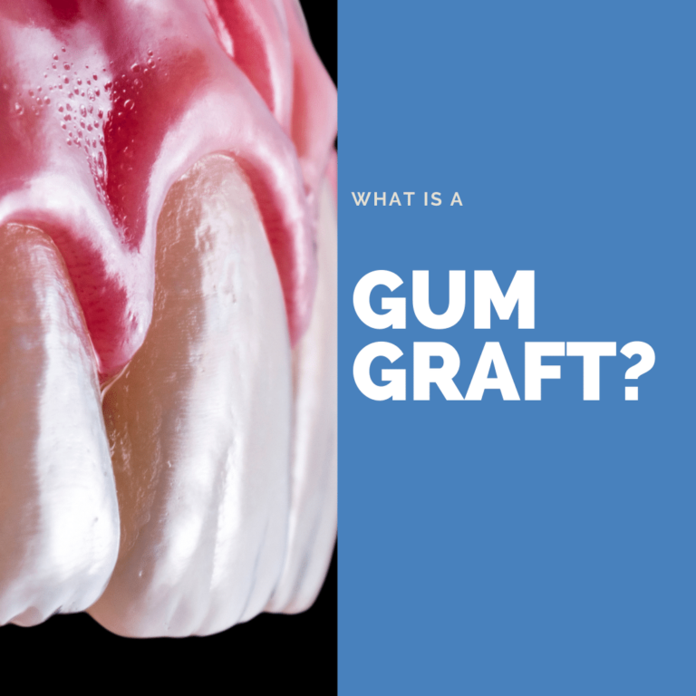 What is a Gum Graft