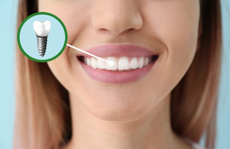 5 Reasons To Gift Yourself Dental Implants For The New Year