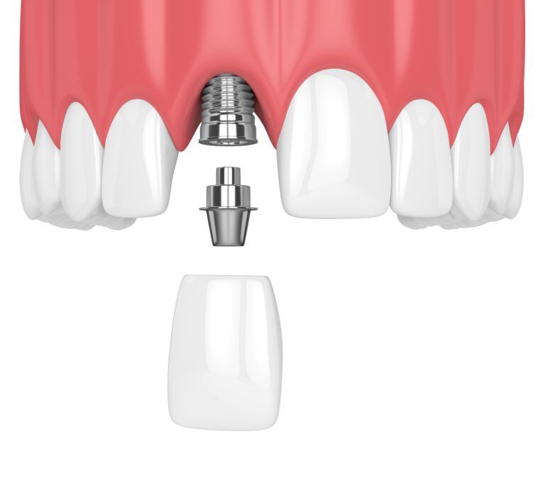 3d render of upper jaw with teeth and dental incisor implant over white background