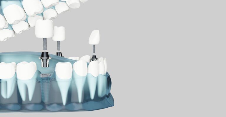 dental implants in lower jaw