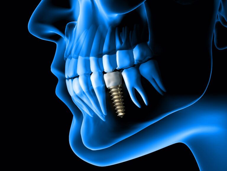 blue side profile of face with visible teeth and dental implant