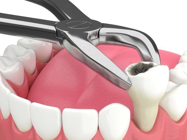 dental extraction of decayed tooth