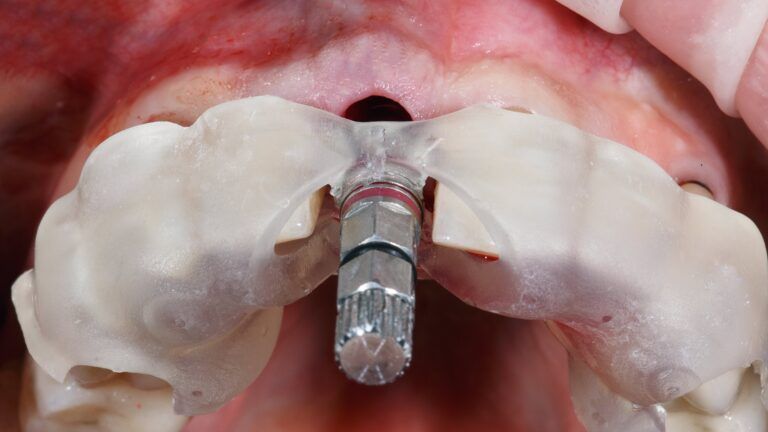 guided dental implant placement using surgical guide